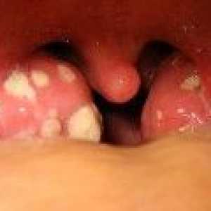Peritonzilarnog apsces: simptoma, liječenje