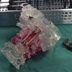 Prvi implantacija 3d vertebralne pacijentu s rakom