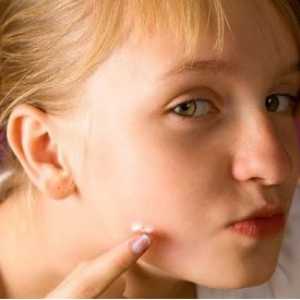 Zašto se i kako ukloniti akne na obrazima