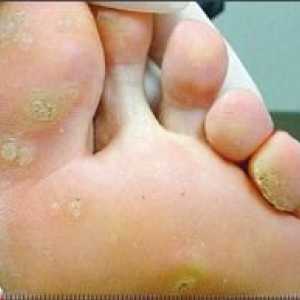 Bradavice na stopalima: Uzroci i tretmani