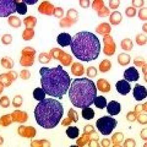 Povećana limfocita u krvi odrasle osobe, dijete, razlog