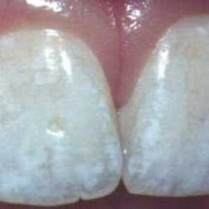 Uzroci bijele mrlje na zubima
