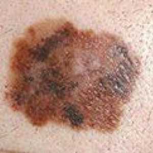 Prognoze životni vijek od melanoma kože