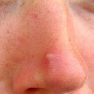 Prištići na nos: Uzroci, liječenje i prevenciju