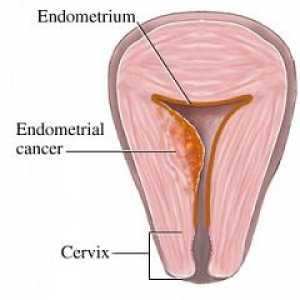 Karcinom endometrija