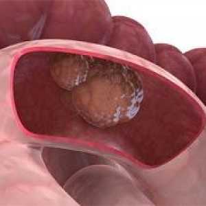 Rak debelog crijeva