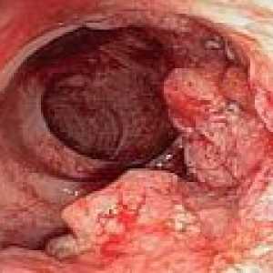 Raka debelog crijeva - tretman i prognozu