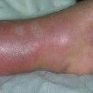 Erizipele noge - simptoma, liječenje