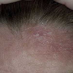Seborejični dermatitis: simptomi, uzroci, liječenje
