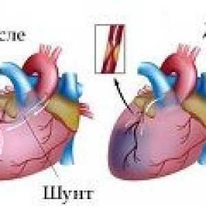Srce bypass operacije žila (presađivanja premosnice koronarnih arterija)