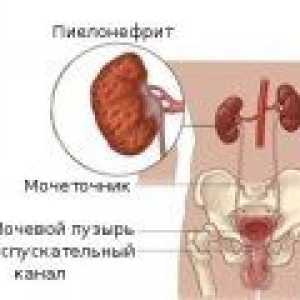 Simptomi kroničnog pijelonefritisa kod žena, kod muškaraca