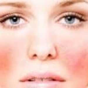 Simptomi i liječenje alergija na licu