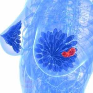 Simptomi i liječenje raka dojke cista