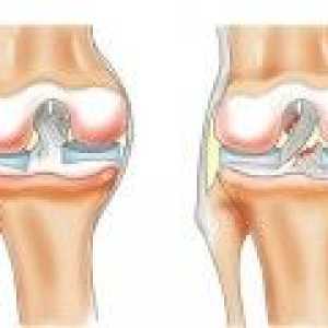 Simptomi i liječenje rupture meniskusa zgloba koljena