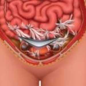 Simptomi i liječenje crijevnih priraslica