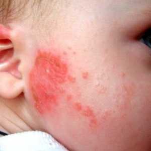 Simptomi i liječenje šarlaha u djece