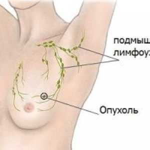 Simptomi raka dojke