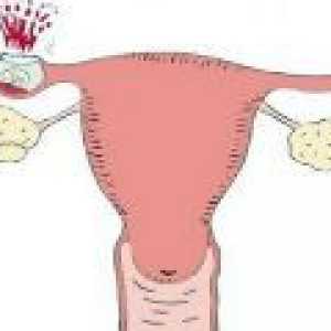 Simptomi izvanmaternične trudnoće u ranoj trudnoći
