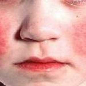 Kawasaki sindrom u djece: uzroci, dijagnoza, liječenje