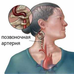 Sindrom kičmene arterije u vratnoj osteochondrosis: simptoma, sprečavanje
