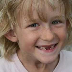 Zamjena zuba u djece
