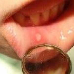Stomatitis u odraslih: što i kako se postupa stomatitis u ustima?