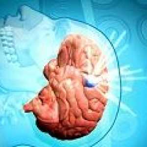 Subduralni hematom na mozgu: uzroci, simptomi, liječenje