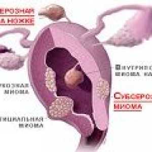 Subserous fibroidi maternice - uzroci, simptomi, liječenje