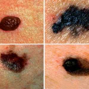 Vrste melanoma i njihovu klasifikaciju