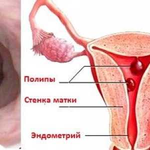 Uklanjanje endometrija polipa: kako postupamo
