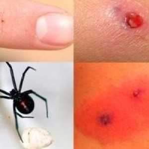 Spider ugriza - simptomi, liječenje