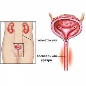 Uretritis