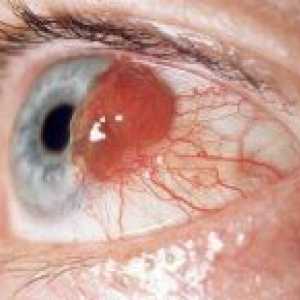 Arkom melanom ili rak oka: kako prepoznati i liječiti