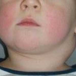 Povećani limfni čvorovi na vratu djeteta. Uzroci i liječenje.