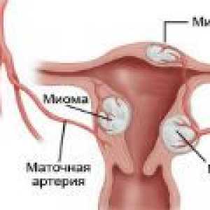 Nodularni fibroidi maternice - uzroci, simptomi, liječenje