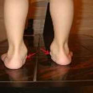 Valgus ravnih stopala u djece: uzroci i liječenje