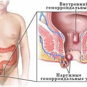Unutarnji hemoroidi - simptomi