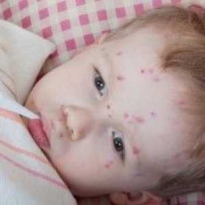 Osip na koži kod djece, kako liječiti?