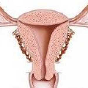 Žljezdane hiperplazija endometrija - uzroci, liječenje