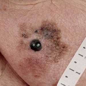 Zlokachesvtennaya lentigo melanom: obilježja bolesti i liječenje